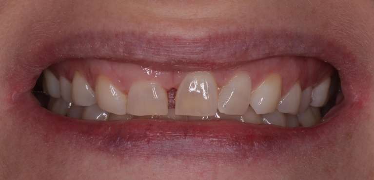 Free-Trial-Smile-Before-Image