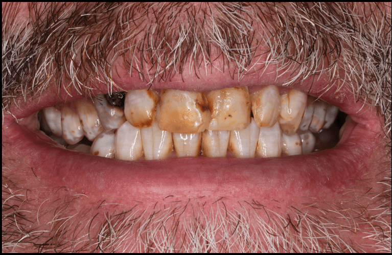 Full-Mouth-Rehab-Before-Image