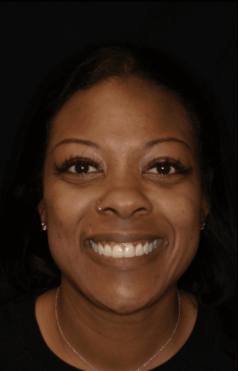Gum-Lift-and-Cosmetic-Crowns-Before-Image