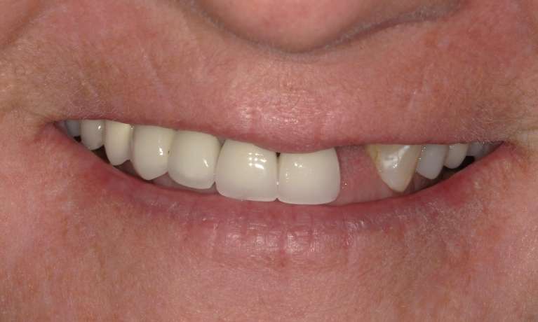 Tooth-Replacement-with-Dental-Implants-Before-Image