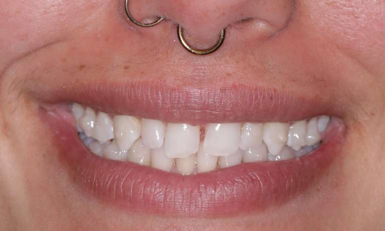 Before Invisalign and Cosmetic Crowns