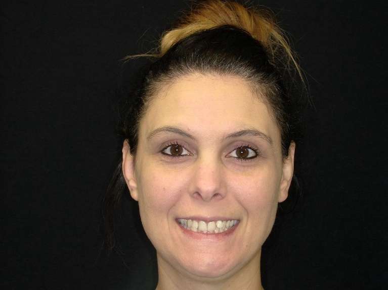 patient with slightly crooked smile