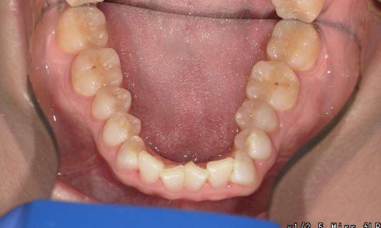 crooked bottom teeth
