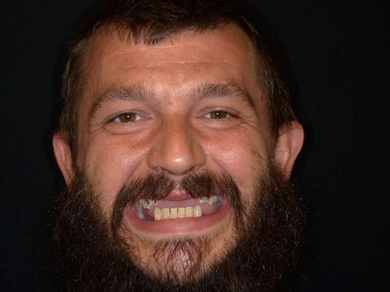 patient with missing upper and lower teeth