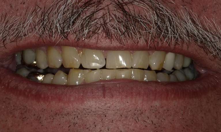 worn and discolored teeth