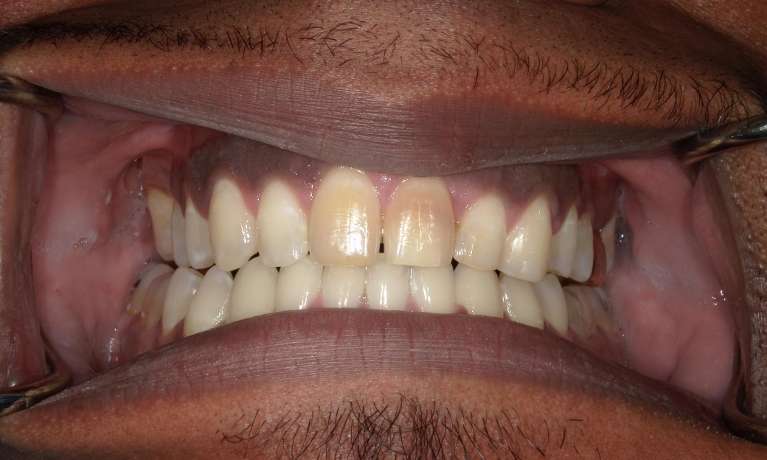 discolored teeth
