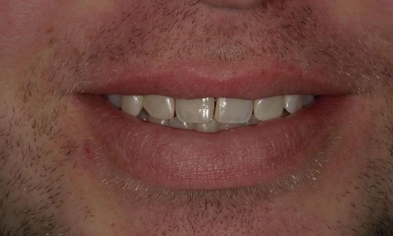 slightly crooked teeth