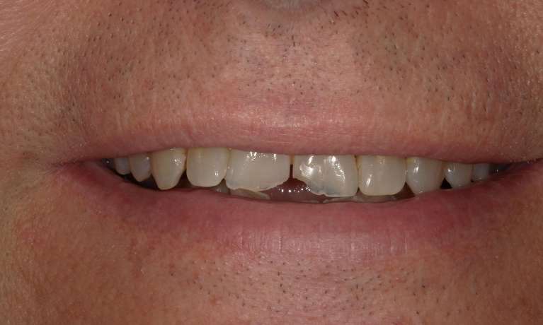 front teeth with chip and gap in smile