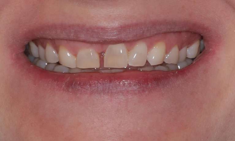 gap between two small front teeth