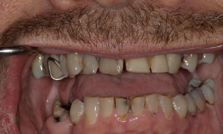 worn teeth