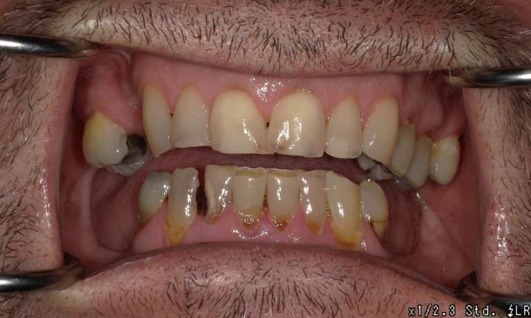discolored and worn teeth