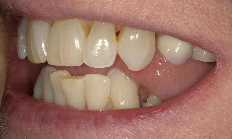 crooked and discolored teeth