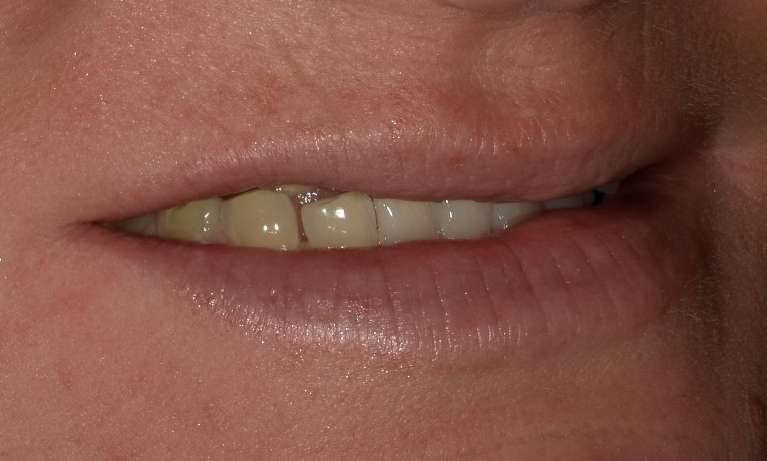 Before Cosmetic Crowns in Evansville, IN
