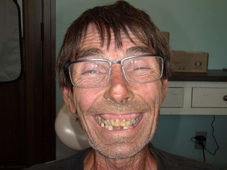 worn and missing teeth