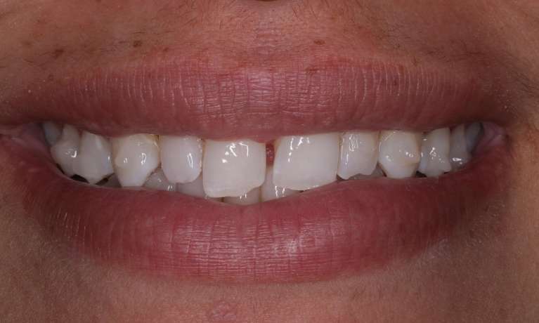 Before Invisalign and Cosmetic Crowns in Evansville, IN