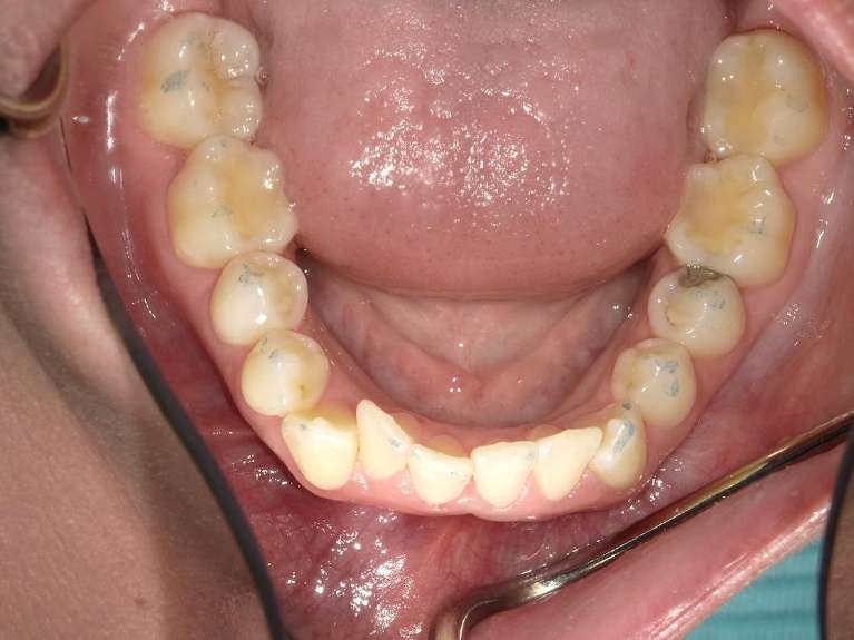 crooked bottom teeth