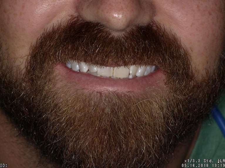 patient's before invisalign