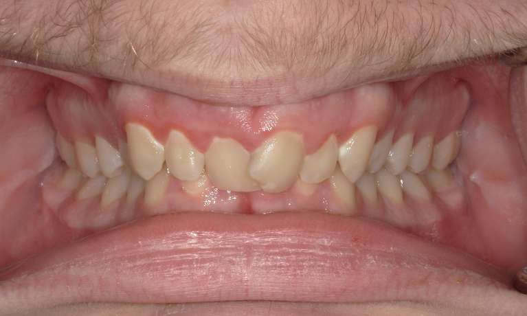 crooked front teeth before invisalign