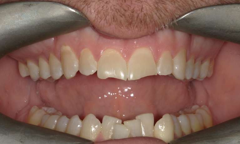 crowded bottom teeth before invisalign