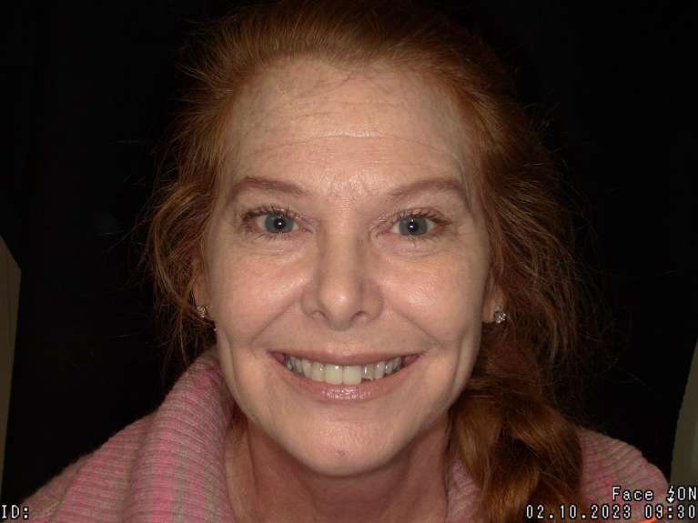 patient with chipped top teeth