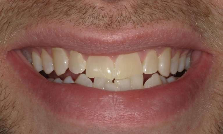 discolored and misshapen teeth