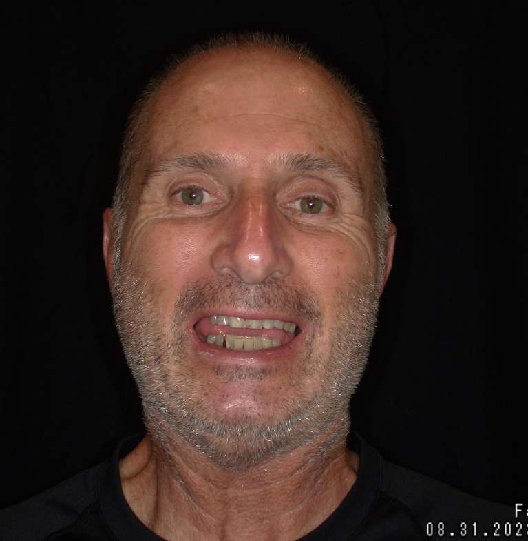 patient with discolored and worn teeth