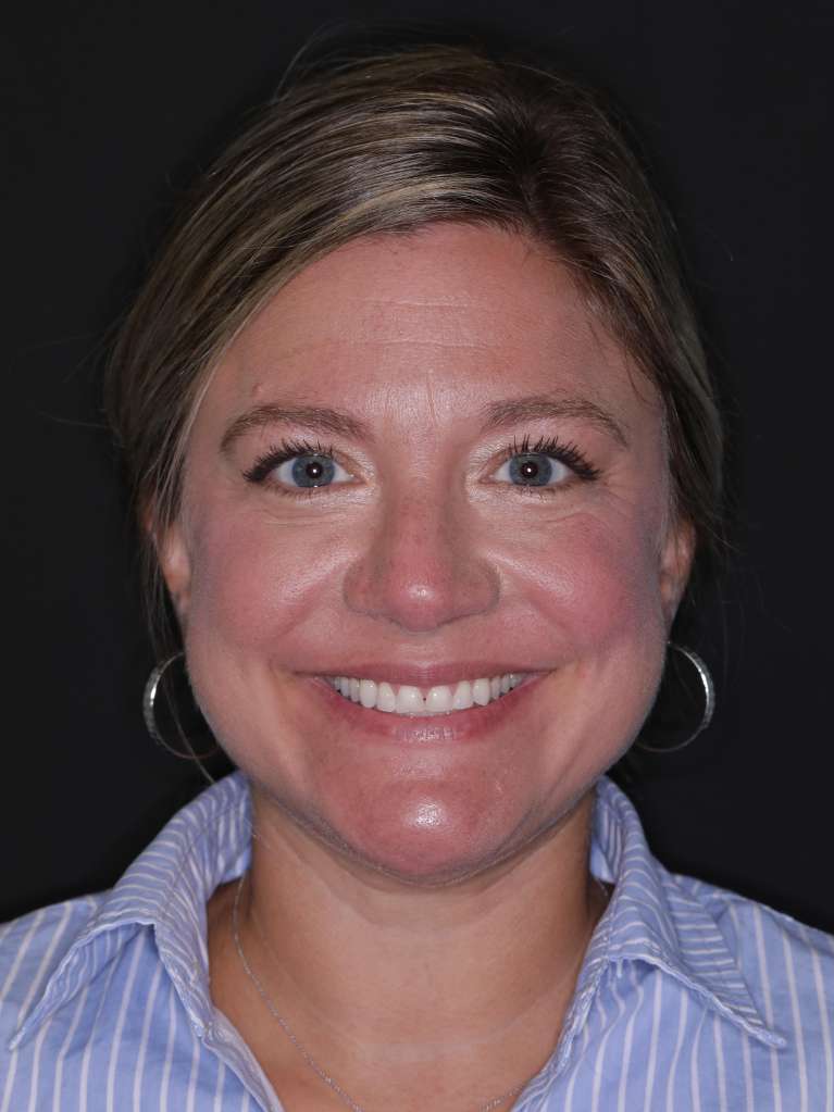 worn top teeth