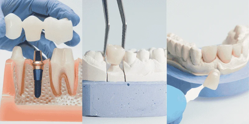 Crowns, Bridges, and Veneers