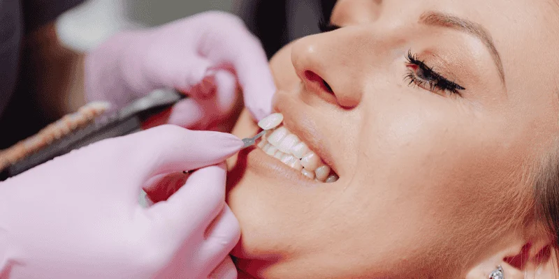 Custom Veneer Creation and Placement