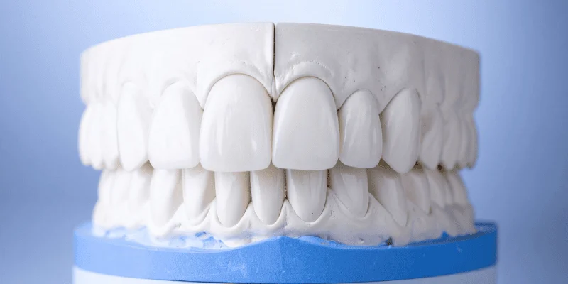 Porcelain vs Composite Veneers