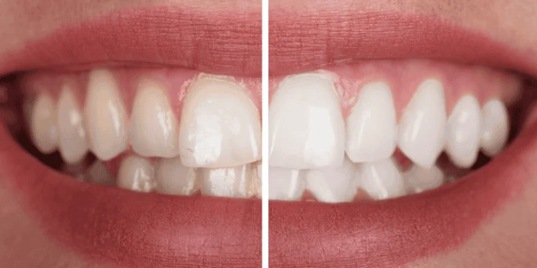 Professional-Teeth-Whitening-At-Home