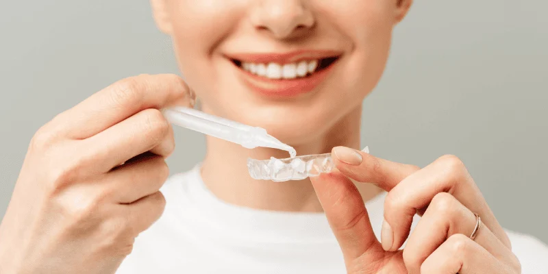 Take-Home Whitening Trays Convenience and Customization