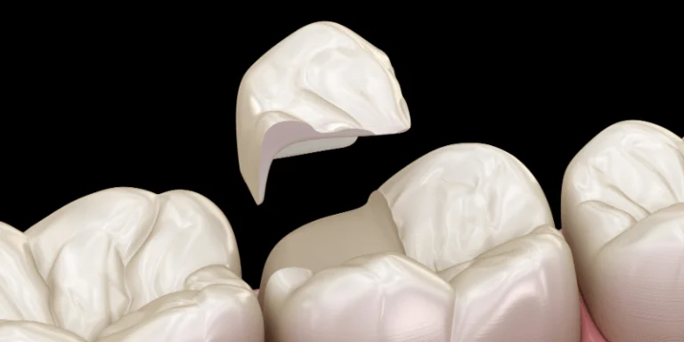 crown vs onlay dentistry