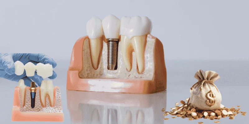 dental implants vs bridge cost