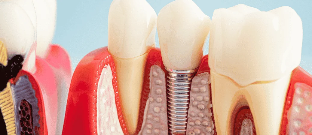 root canal vs dental implant
