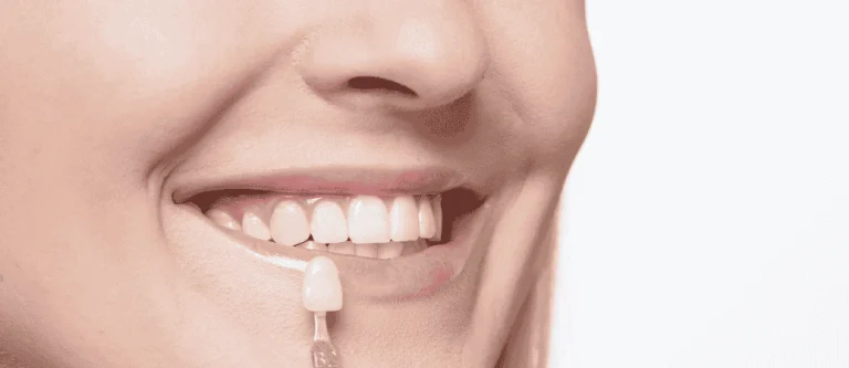 trial smile before veneers