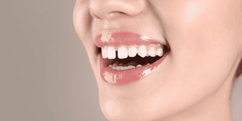 veneers for gaps in teeth