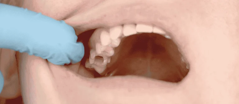 what happens if you ignore a cavity