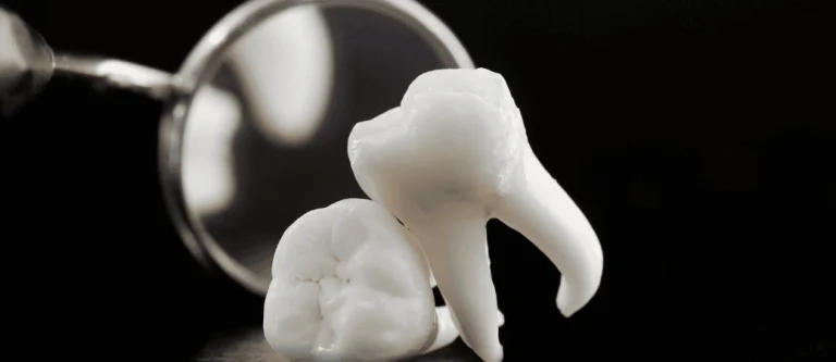 wisdom teeth removal in your s